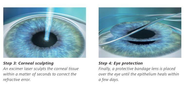 Prk Laser Eye Surgery Laser Eye Surgery Procedures Adv Vision Centers