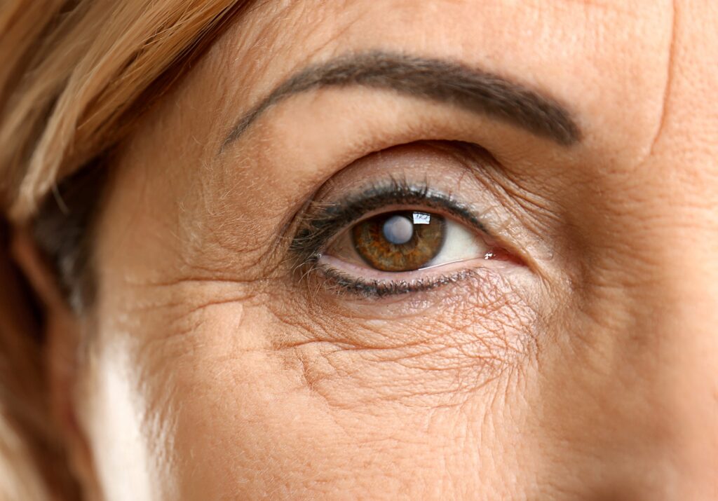 Debunking the Myths Surrounding Natural Cataract Treatment